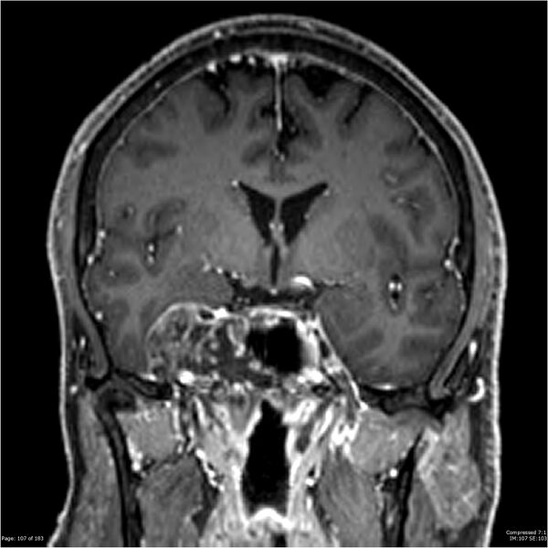 File:Chondrosarcoma of skull base- grade II (Radiopaedia 40948-43654 Coronal T1 C+ 18).jpg