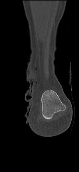 File:Chopart fracture (Radiopaedia 35347-36851 Coronal bone window 11).jpg