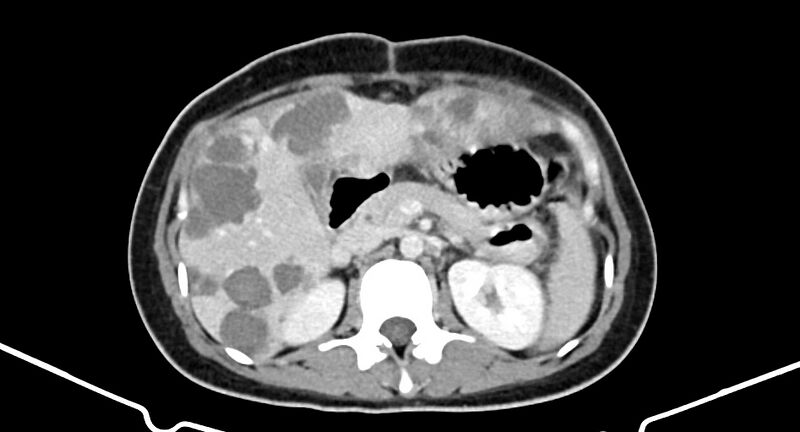 File:Choriocarcinoma liver metastases (Radiopaedia 74768-85766 A 82).jpg