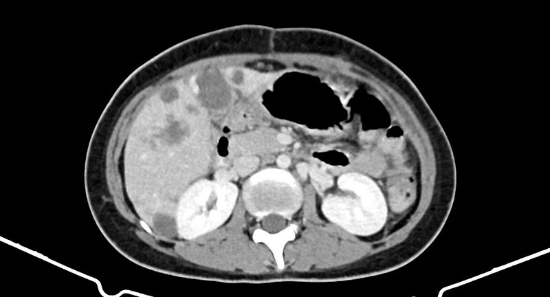 File:Choriocarcinoma liver metastases (Radiopaedia 74768-85766 A 92).jpg