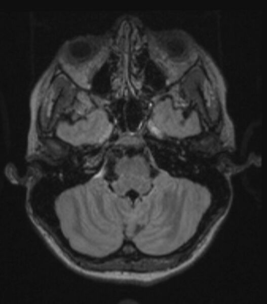File:Choroid plexus carcinoma (Radiopaedia 91013-108553 Axial FLAIR C+ 90).jpg