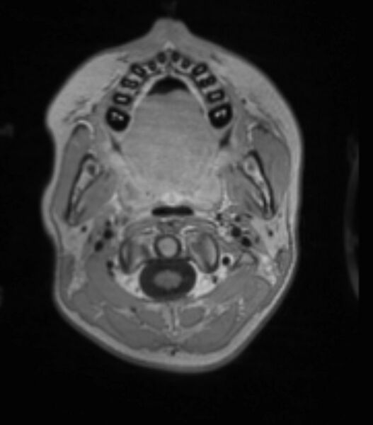 File:Choroid plexus carcinoma (Radiopaedia 91013-108553 Axial T1 C+ 53).jpg