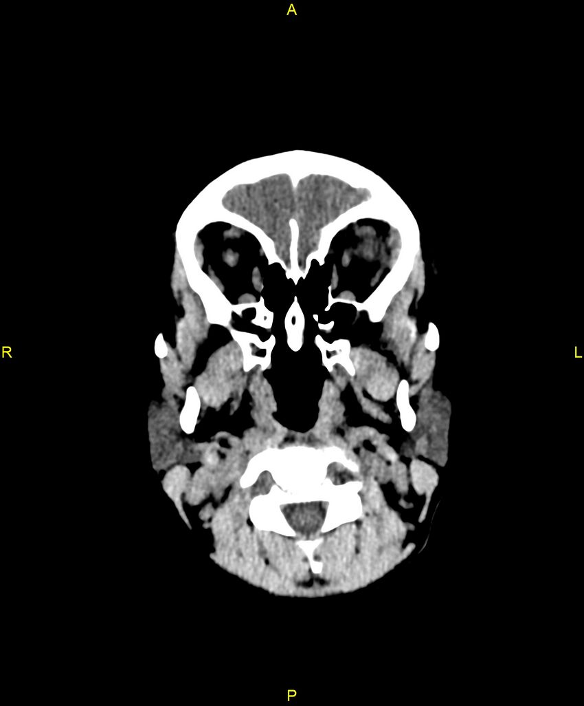 Choroidal fissure cyst (Radiopaedia 89481-106465 Axial non-contrast 13).jpg