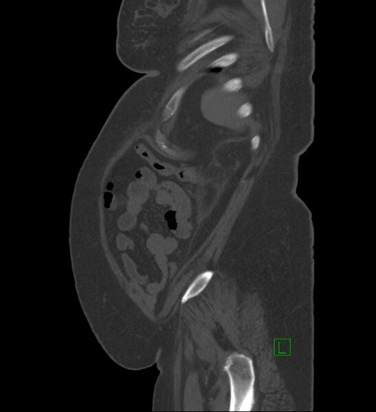 File:Chromophobe renal cell carcinoma (Radiopaedia 84239-99519 Sagittal bone window 13).jpg