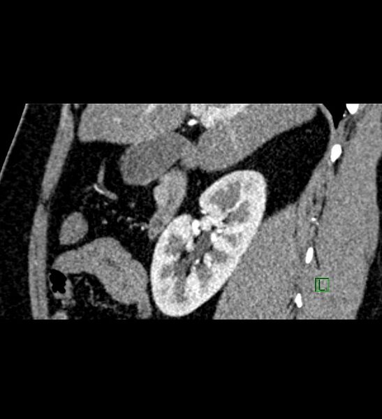 File:Chromophobe renal cell carcinoma (Radiopaedia 84286-99573 F 114).jpg