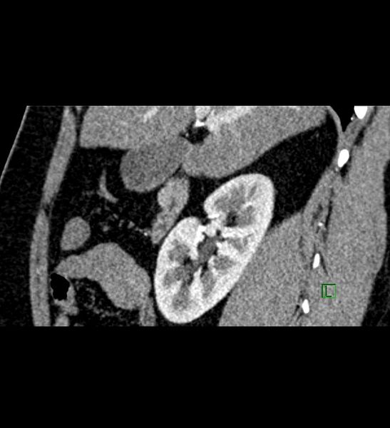 File:Chromophobe renal cell carcinoma (Radiopaedia 84286-99573 F 115).jpg