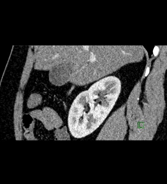 File:Chromophobe renal cell carcinoma (Radiopaedia 84286-99573 F 121).jpg