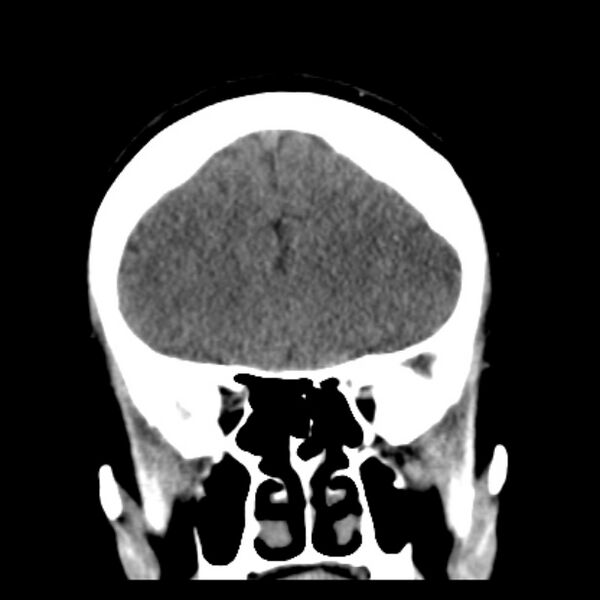 File:Chronic bilateral occipital lobe infarcts (Radiopaedia 31276-31996 Coronal non-contrast 16).jpg