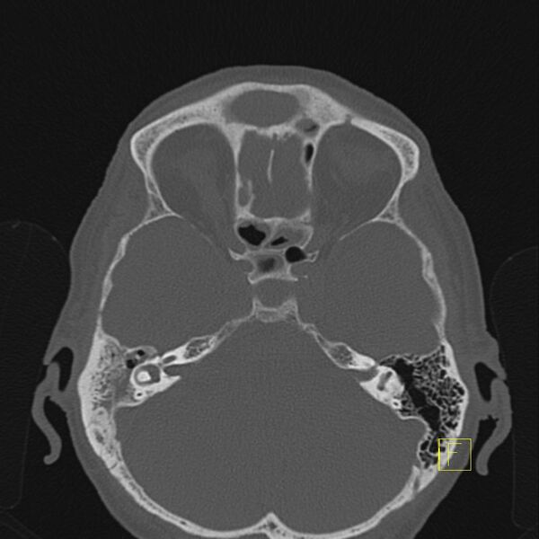 File:Chronic otitis media (Radiopaedia 14994-14912 Axial bone window 5).JPEG