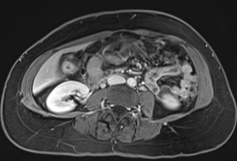File:Chronic pancreatitis - pancreatic duct calculi (Radiopaedia 71818-82250 Axial T1 C+ fat sat 46).jpg