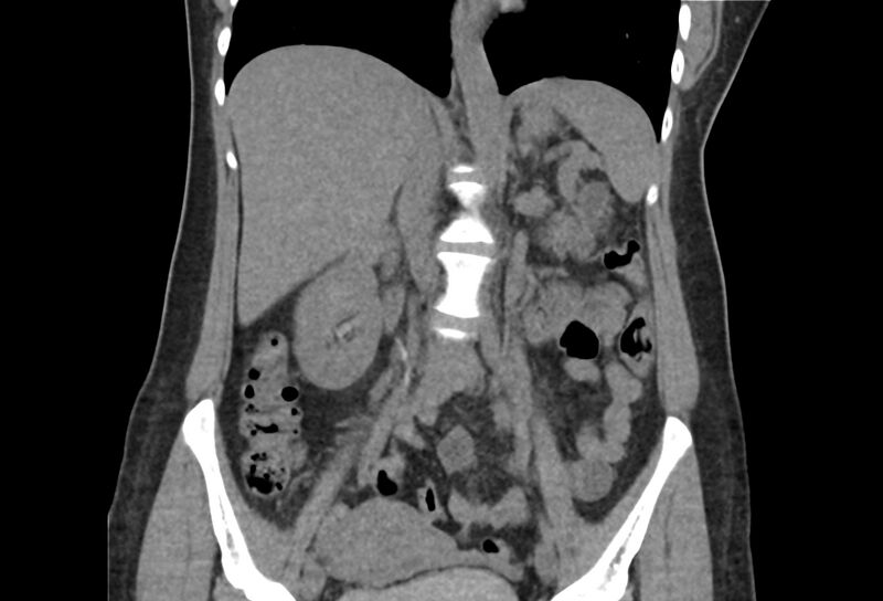 File:Chronic pancreatitis - pancreatic duct calculi (Radiopaedia 71818-82251 Coronal non-contrast 24).jpg