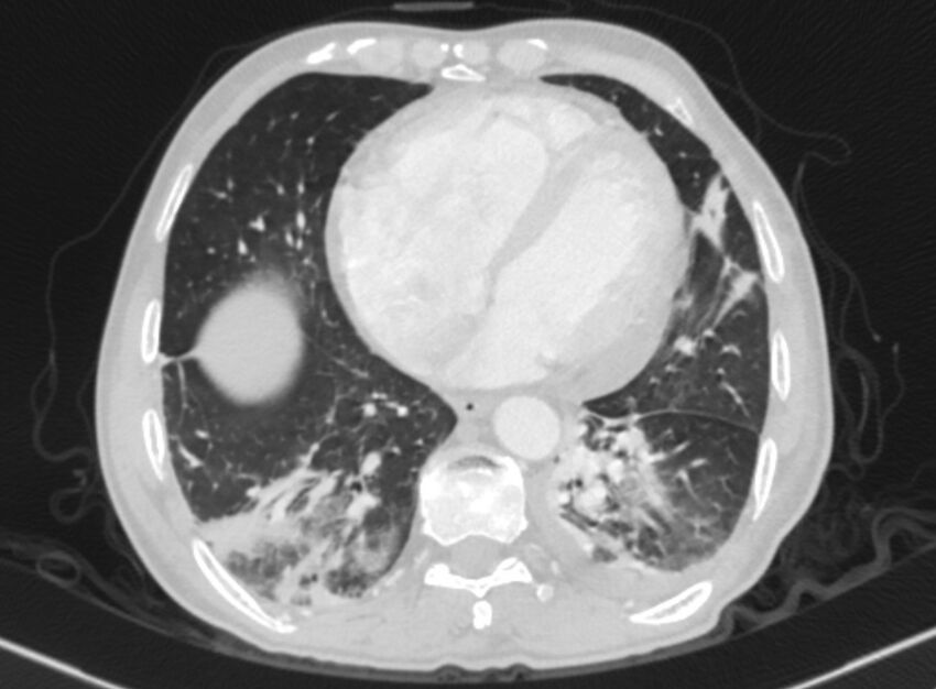 Chronic pulmonary embolism with bubbly consolidation (Radiopaedia 91248-108850 Axial lung window 113).jpg