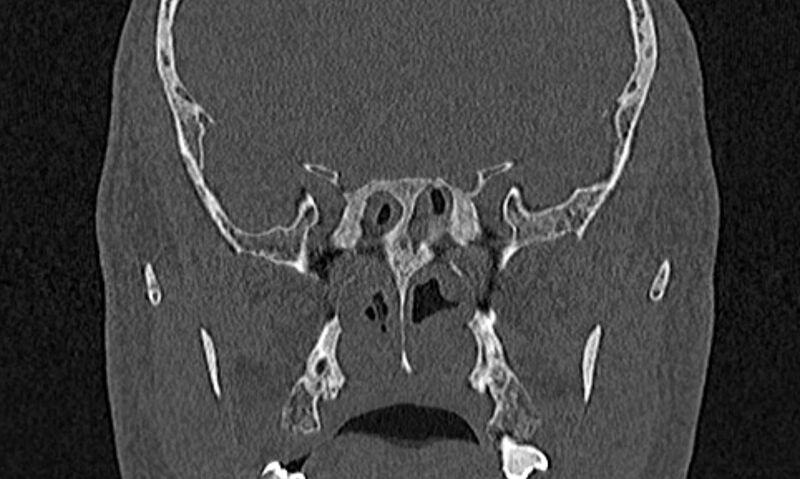 File:Chronic rhinosinusitis (Radiopaedia 65079-74075 Coronal bone window 62).jpg