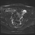 Class II Mullerian duct anomaly- unicornuate uterus with rudimentary horn and non-communicating cavity (Radiopaedia 39441-41755 Axial T2 fat sat 10).jpg