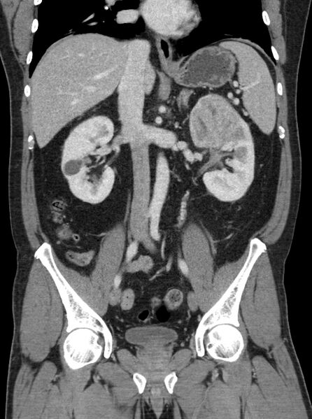 File:Clear cell renal cell carcinoma (Radiopaedia 61449-69393 F 20).jpg