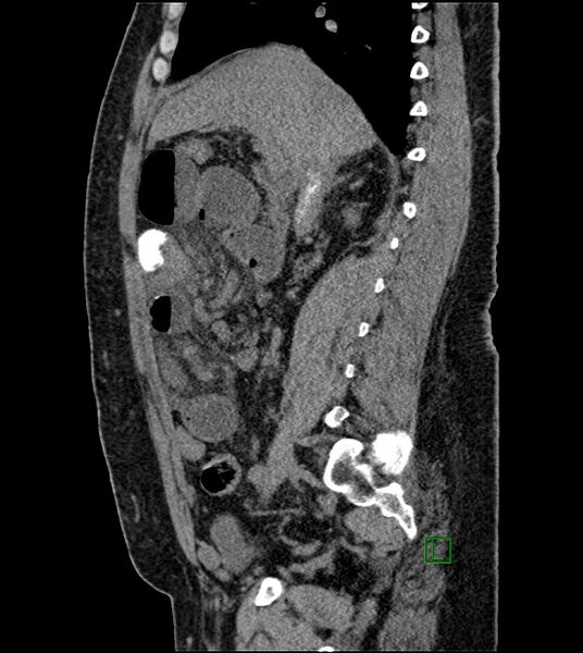 File:Closed-loop small bowel obstruction-internal hernia (Radiopaedia 78439-91096 C 89).jpg