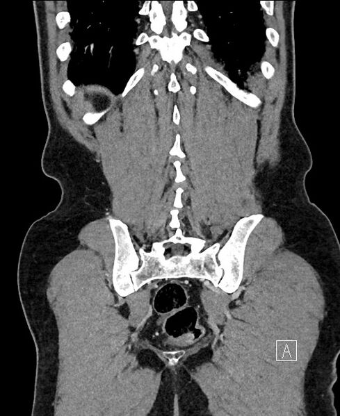 File:Closed loop small bowel obstruction - internal hernia (Radiopaedia 57806-64778 A 102).jpg