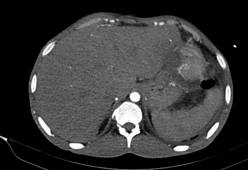 File:Coarctation of aorta with aortic valve stenosis (Radiopaedia 70463-80574 A 219).jpg