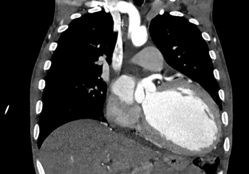File:Coarctation of aorta with aortic valve stenosis (Radiopaedia 70463-80574 C 92).jpg