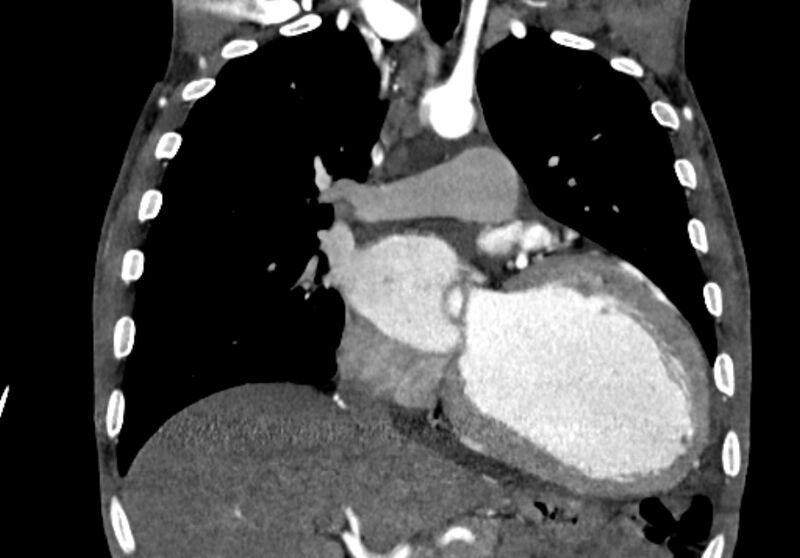 File:Coarctation of aorta with aortic valve stenosis (Radiopaedia 70463-80574 C 99).jpg