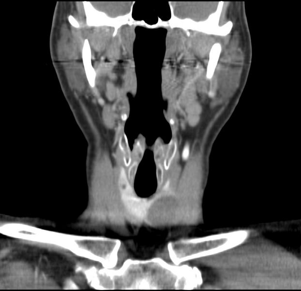 File:Colloid cyst of thyroid (Radiopaedia 22897-22923 Coronal C+ delayed 26).jpg