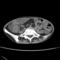 Colocolic fistula - Crohn disease (Radiopaedia 57063-63955 A 55).jpg