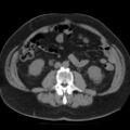 Colonic fistula (Radiopaedia 16047-15707 Axial non-contrast 26).jpg