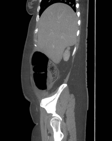 File:Colonic pseudo-obstruction (Radiopaedia 79752-92980 C 19).png