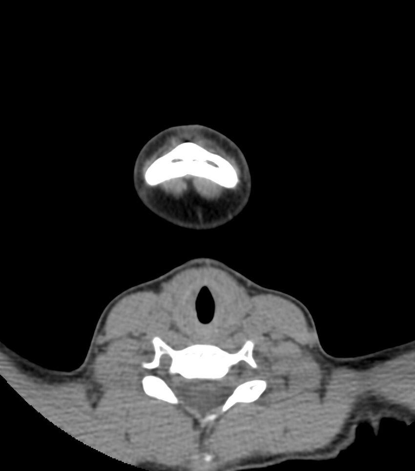 Nasoorbitoethmoid fracture (Radiopaedia 90044-107205 Axial non-contrast 19).jpg