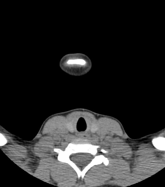 File:Nasoorbitoethmoid fracture (Radiopaedia 90044-107205 Axial non-contrast 8).jpg