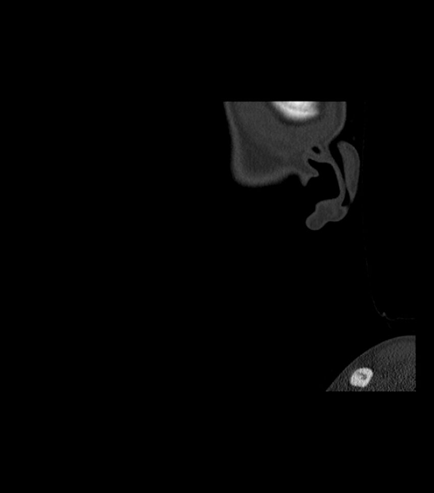 Nasoorbitoethmoid fracture (Radiopaedia 90044-107205 Sagittal bone window 140).jpg