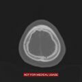Nasopharyngeal carcinoma recurrence - skull base destruction (Radiopaedia 29107-29490 Axial bone window 11).jpg