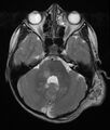 Neurofibromatosis type 1 (Radiopaedia 6954-8063 Axial T2 3).jpg