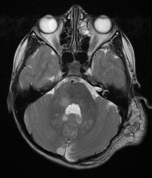 File:Neurofibromatosis type 1 (Radiopaedia 6954-8063 Axial T2 3).jpg