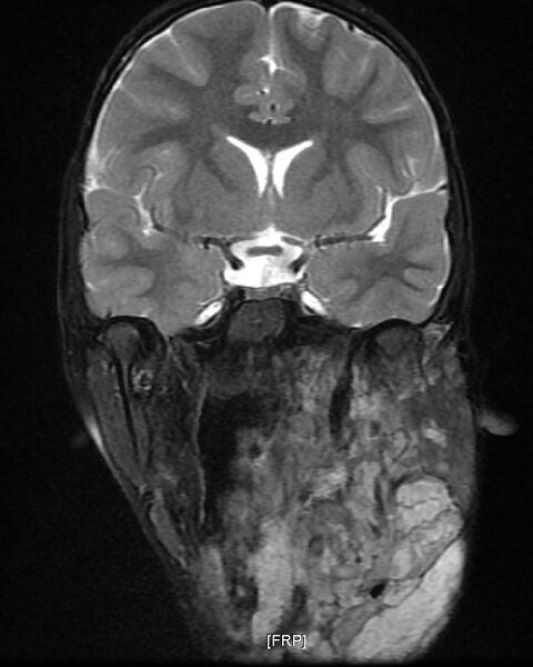 File:Neurofibromatosis type 1 (Radiopaedia 6954-8063 Coronal T2 5).jpg