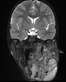 Neurofibromatosis type 1 (Radiopaedia 6954-8063 Coronal T2 5).jpg
