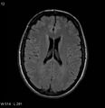 Neurosarcoidosis (Radiopaedia 10930-17204 Axial FLAIR 12).jpg