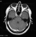 Neurosarcoidosis (Radiopaedia 10930-17204 Axial T1 C+ 5).jpg