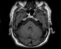 Non-Hodgkin lymphoma - parotid gland (Radiopaedia 71531-81890 Axial T1 23).jpg