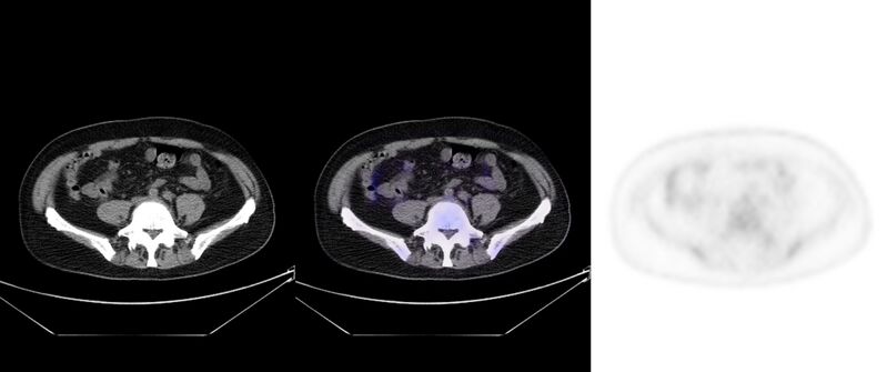 File:Non-Hodgkin lymphoma involving seminal vesicles with development of interstitial pneumonitis during Rituximab therapy (Radiopaedia 32703-33752 ax CT Fus PET 49).jpg
