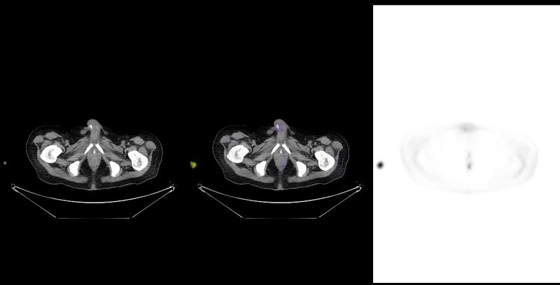 File:Non-Hodgkin lymphoma involving seminal vesicles with development of interstitial pneumonitis during Rituximab therapy (Radiopaedia 32703-33761 ax CT Fus PET 60).jpg