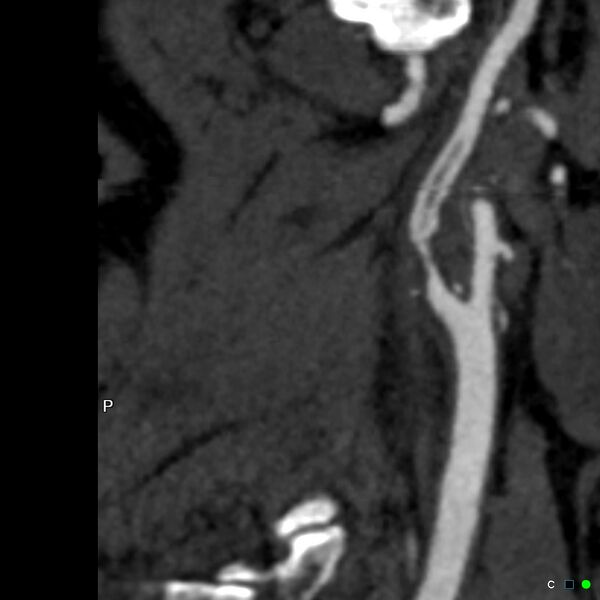 File:Non-occlusive intraluminal internal carotid artery thrombus (Radiopaedia 37751-39658 A 19).jpg