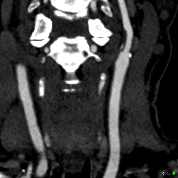 File:Non-occlusive intraluminal internal carotid artery thrombus (Radiopaedia 37751-39658 C 1).jpg