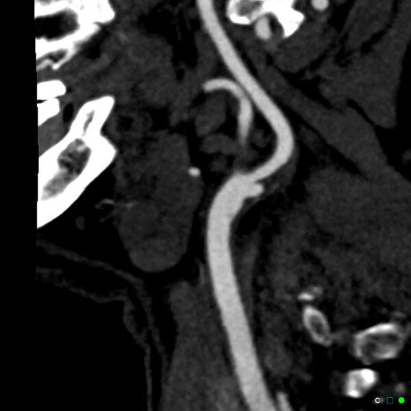 File:Non-occlusive intraluminal internal carotid artery thrombus (Radiopaedia 37751-39658 C 56).jpg