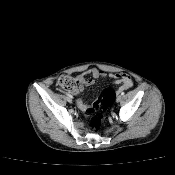 File:Non small-cell lung cancer (Radiopaedia 24467-24769 C+ delayed 104).jpg