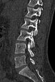 Normal CT lumbar spine (Radiopaedia 53981-60118 Sagittal bone window 39).jpg