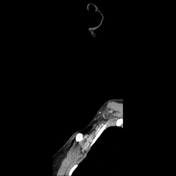 File:Normal CT of the neck (Radiopaedia 14575-14500 Sagittal C+ 3).jpg
