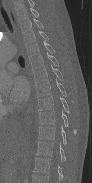 File:Normal CT thoracic spine (Radiopaedia 40181-42688 Sagittal bone window 31).png