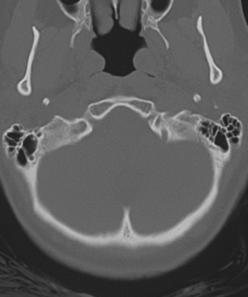 File:Normal cervical spine MRI (including Dixon) (Radiopaedia 42762-45926 Axial bone window 6).png