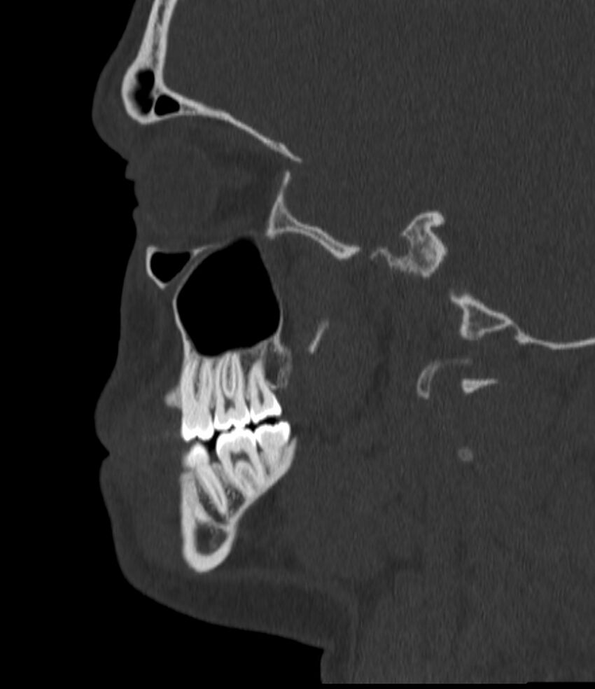 Normal facial bone CT (Radiopaedia 88742-105476 Sagittal bone window 60).jpg